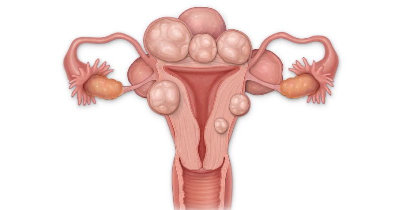 How Much Green Tea Extract Is Needed To Shrink Fibroids_2