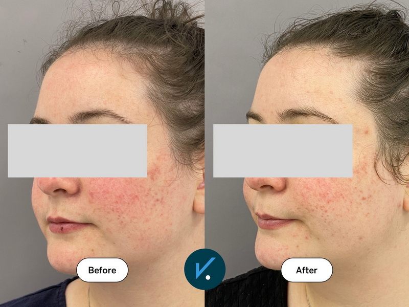 Green Tea Extract Good for Rosacea_1 Green Tea Extract Good for Rosacea_1